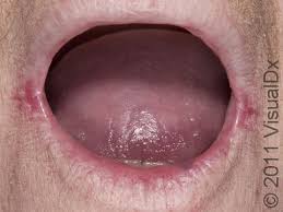Image result for Angular Stomatitis