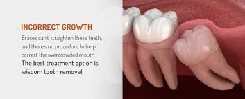 It is important to leave the first gauze in the mouth for at least a after the clot has formed, it is vital to keep it securely in place and to follow some extra steps for oral. Wisdom Teeth Removal Recovery Faq Guide Fox Kids Dentistry