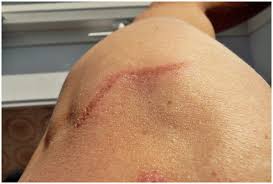 Leg Bio Oil Before And After Scars Pin On Bio Oil Diy