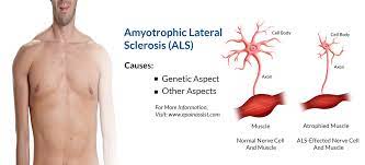 Currently, als does not have a cure, but treatments exist to relieve symptoms and improve patients' quality of life. Amyotrophic Lateral Sclerosis Als Or Lou Gehrig S Disease Symptoms Treatment