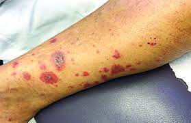 Senile purpura is benign, easy bruising that affects older adults. December 2018 Mdedge Dermatology