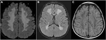 Sjogren Larsson Syndrome Mechanisms And Management Tacg