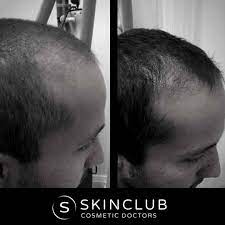 Trichology is the scientific study of the hair and scalp, devolving as a specialised discipline from dermatology in 1902. Hair Loss Treatments Hair Rejuvenation Treatments Skin Club