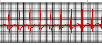 Teens free when accompanied by paying adult. Supraventricular Tachycardia Vs Sinus Tachycardia Epomedicine