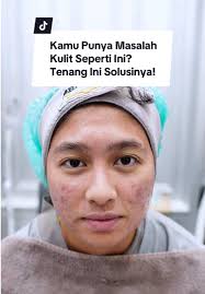 Bekas jerawat dan scar kaya gini emang ganggu banget bikin gak pede!  Untungnya di Bening's Clinic bisa diatas dengan Laser Canggih namanya Laser  Picosure😍 #KlinikTerpercaya #treatment #Picosure ...