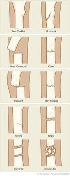 Types Of Fractures Medical School Studying Nursing School Nurse