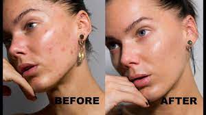 Learn which dark spot skin treatments actually work. How To Cover Up Spots Without Covering Your Face Some Self Love Linda Hallberg Tutorials Youtube