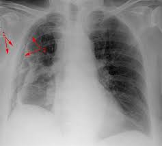 When pneumothorax with its accompanying emphysema occurs as a complication of bronchoscopy, symptoms are usually severe, and require treatment. Spontanpneumothorax Deximed