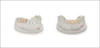 Pfm Vs Zirconia Which Material Is Better