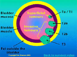 It usually becomes noticeable in the early stage of bladder. Bladder Cancer Squamous Cell Carcinoma Of The Bladder Healthengine Blog