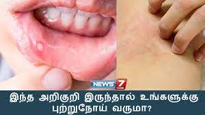 Throat cancer is a rare form of cancer. à®‡à®¨ à®¤ à®…à®± à®• à®± à®‡à®° à®¨ à®¤ à®² à®‰à®™ à®•à®³ à®• à®• à®ª à®± à®± à®¨ à®¯ à®µà®° à®® à®Ÿ à®• à®Ÿà®° à®š à®µà®° à®® à®•à®© à®šà®® à®© News7 Tamil Youtube