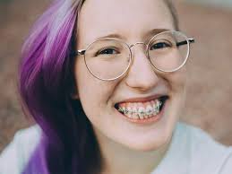 Mar 01, 2021 · some people do end up with stained teeth after braces, and even white spots, but it's not necessarily the braces themselves that are to blame. Causes Of Post Braces Stains On Teeth How To Remove Them