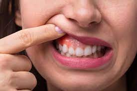 Why Gum Contouring Is So Popular Among Celebrities David A Blaustein Dds Comprehensive Cosmetic And Implant Dentistry