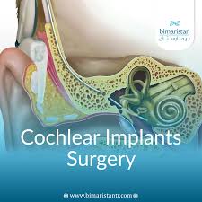 Image result for Cochlear Implant