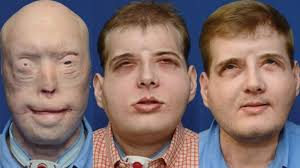 Amazing transformation: Face transplant surgery gives firefighter his life  back