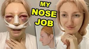 Facetouchup helps you visualize cosmetic surgery results from the comfort of your own home. My Nose Job Part 1 Rhinoplasty Septoplasty Surgery Recovery 2020 Youtube