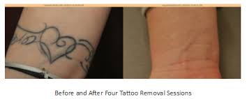 Surgical tattoo removal & tattoo excision in london, harley street. Is Laser Tattoo Removal Safe Vernon Hills Chicago Il Ritacca Cosmetic Surgery Medspa