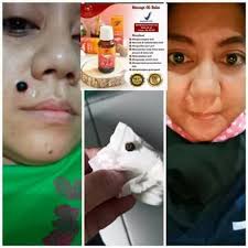 Tahi lalat yang bukan termasuk kanker biasanya memang tidak berbahaya. Minyak Bulus Asli Obat Penghilang Tahilalat Ampuh Obat Penghilang Tahilalat Di Muka Obat Penghilang Tahilalat Hidup Obat Penghilang Tahilalat Bpom Obat Penghilang Kutil Dileher Obat Penghilang