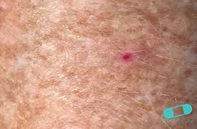 Abnormal cells grow and can form tumors. Basal Cell Carcinoma Basalioma Bcc Online Dermatology