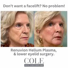 ✨ You don't need a facelift to achieve a renewed, youthful look! During  your consultation, Dr. Cole will explore both surgical and non-surgical  options tailored to give you a natural, refreshed appearance.