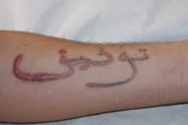 Tattoos aren't more likely to cause keloids than other skin traumas. Tattoos And Keloids Keloid Removal Expert New York