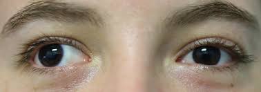 Strabismus Squint A Common Eye Condition And Suggested Treatment