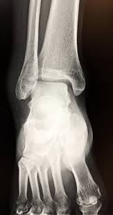Image result for Ankle XRay