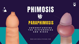Image result for paraphimosis