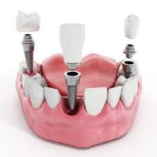 How much you can expect to pay out of pocket for dental work, including what people paid. Hhjgc5vk2fcpum