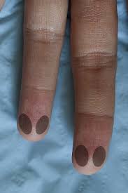 Image result for Capillary Puncture