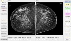 A pelvic ct scan can be used to detect several types of cancer. Assessing Performances Of Computer Aided Diagnosis Of Breast Cancer Research Outreach