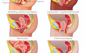 Image result for Pelvic Floor Dysfunction