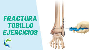 Fractura Del Maleolo Externo Sintomas Y Tratamiento Fisiolution