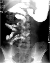 Image result for Midgut Volvulus