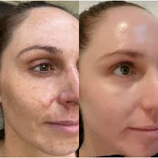 Some of my favourite skin transformations. Which one do you love?  #jennadeeskin #beforeandafterskin #northlakes #brisbane #northlakesbeauty  #northlakesskinclinic
