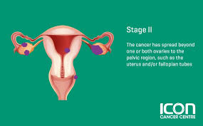 The most commonly adopted ovarian cancer staging system is the figo staging system. Ovarian Cancer Signs Symptoms Icon Centre Singapore