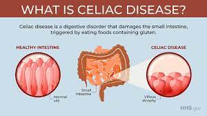 Celiac disease usually manifests in childhood with diarrhea, weight loss and failure to thrive. Hhs Gov No Twitter Celiacdisease Is Unlike A Wheat Allergy Or Gluten Sensitivity With Celiac Eating Gluten Not Only Causes Discomfort It Damages The Small Intestine Learn The Symptoms And How Doctors Diagnose Celiac