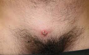 Image result for genital herpes