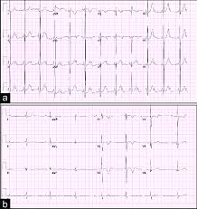 Because the impulse is blocked, an accessory pacemaker in the lower chambers will typically activate the ventricles. A Postoperative Child With Second Degree Heart Block B Download Scientific Diagram
