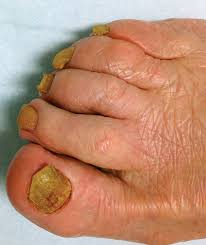 Image result for onychomycosis