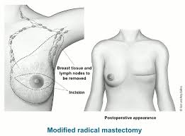 What is a Mastectomy? | American Cancer Society | American Cancer Society
