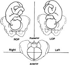 fetal occipito posterior op position there are three op