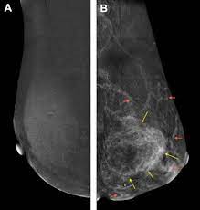 Given the presence of the mesothelium in different parts of the body, mesothelioma can arise in various locations 17:. Breast Metastasis From Malignant Pleural Mesothelioma A Rare Challenging Entity Journal Of Thoracic Oncology