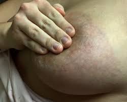 Inflammatory breast cancer is an uncommon form of breast cancer which spreads fast and inflammatory breast cancer is a local cancer of advanced form. 25 Y O Reddish Purple Ish Patches On Breasts Worried Breast Pain Lumps And Disorders Forums Patient