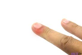 We look at whether these may require medical attention. Hangnails Symptoms Causes Types Remedies Cure Factdr
