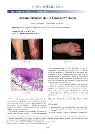 Get the facts on a possible treatment option that works with the immune system. Pdf Purpura Fulminans Due To Enterobacter Cloacae