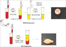 Matrix, the one with numbers, arranged with rows and columns, is extremely useful in most scientific. Evaluation Of Histological And Ph Changes In Platelet Rich Fibrin And Platelet Rich Fibrin Matrix A In Vitro Study Nagaraja S Mathew S Rajaram Rb Pushpalatha C Abraham A Chandanala S Contemp Clin