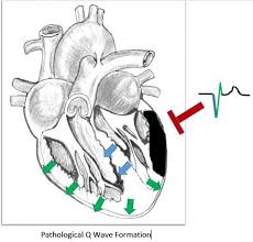 Image result for Q Wave