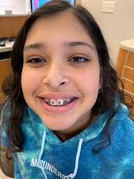 Another factor in the price is how long the braces need to be worn. How Much Do Teeth Braces Cost With Insurance