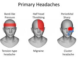 Beautiful Headache Location Chart With Types Of Headache